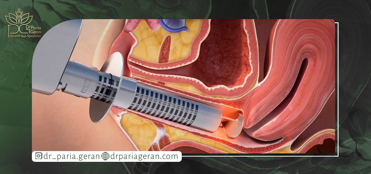 بایدها و نبایدهای پلاسماتراپی واژن
