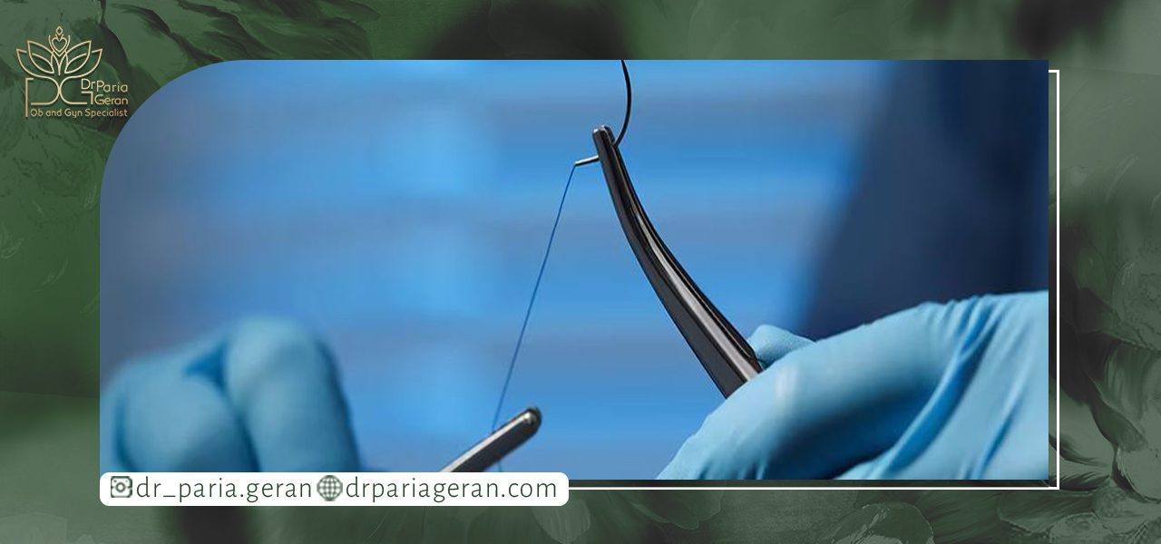 کاهش اسکار بعد از بخیه لابیاپلاستی