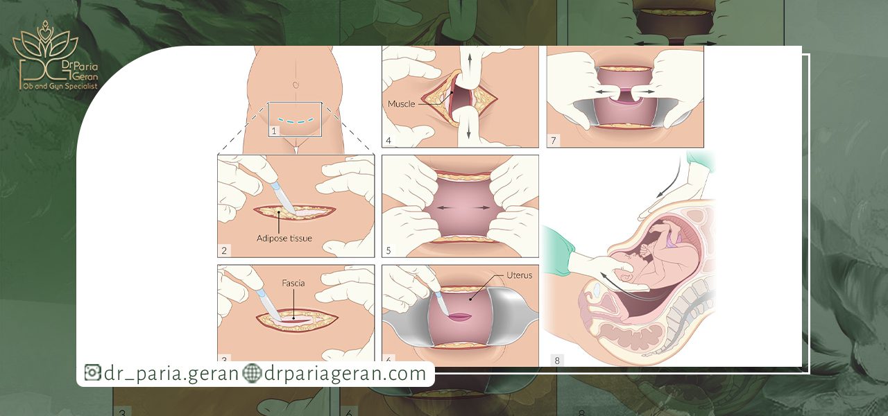 عمل سزارین چگونه انجام می شود؟