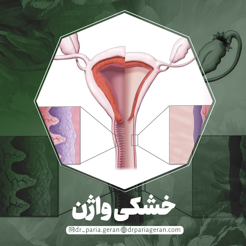راه های درمان خشکی واژن