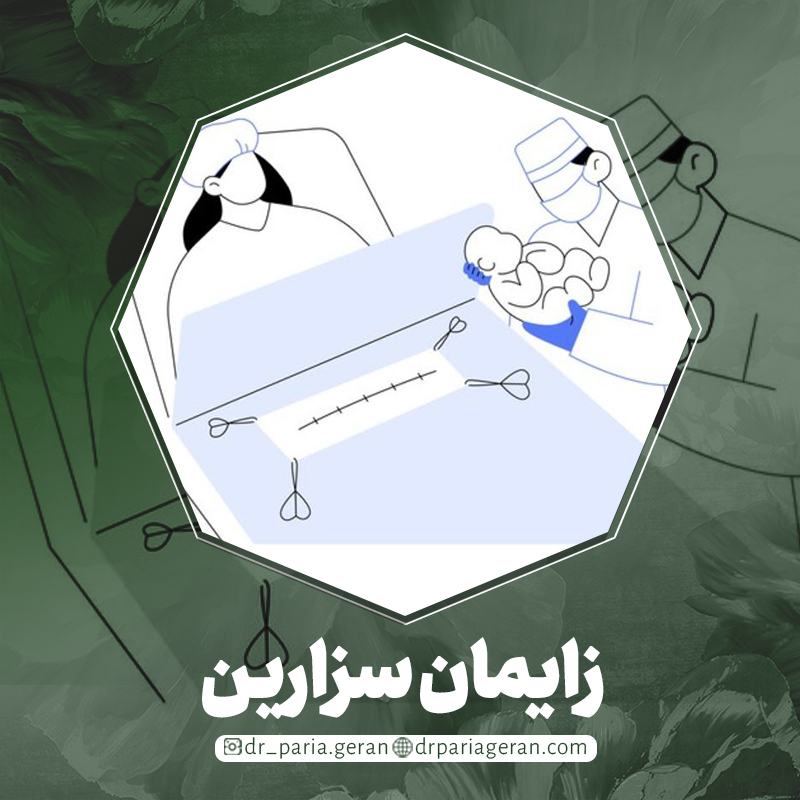زایمان سزارین