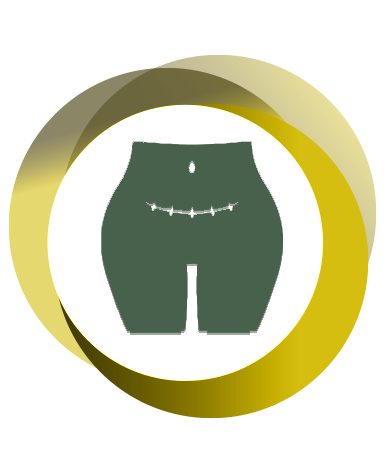 سزارین