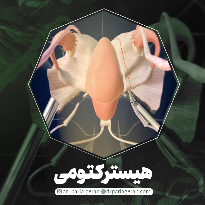 هیسترکتومی و علت انجام آن