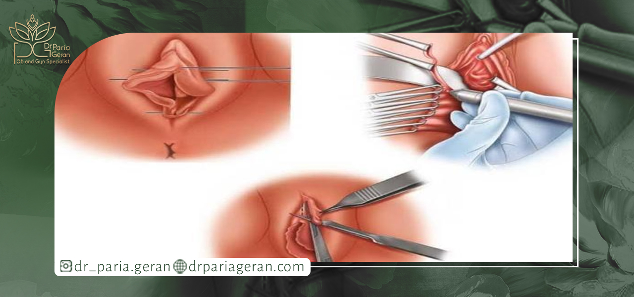چه کسانی باید از لابیاپلاستی اجتناب کنند؟