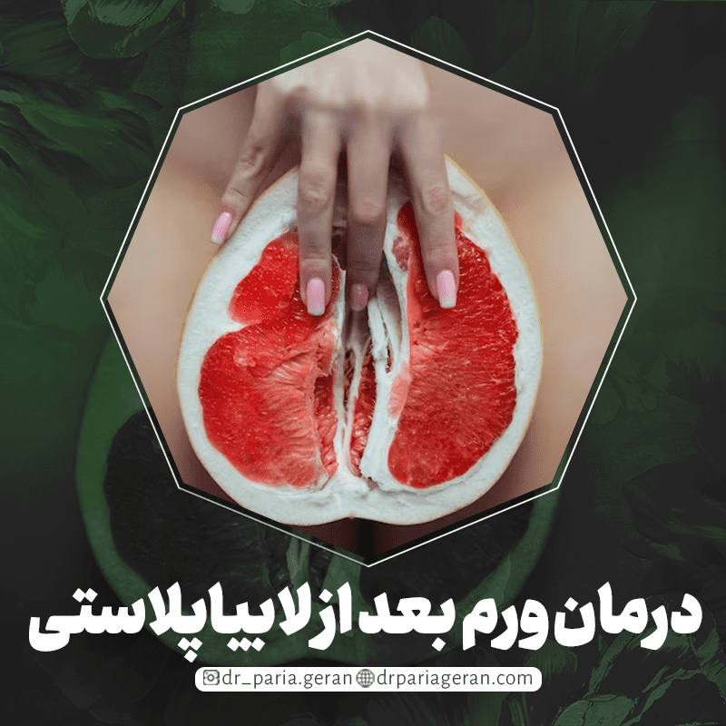 درمان ورم بعد از لابیاپلاستی