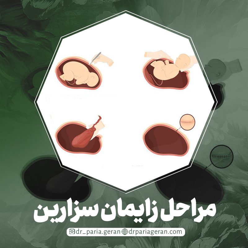 مراحل زایمان سزارین